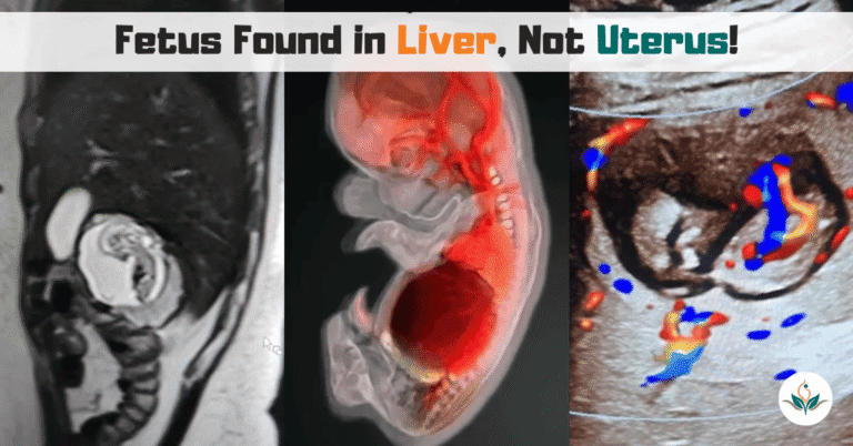What is Intrahepatic Ectopic Pregnancy: Latest Case, Symptoms, Risks & Treatments