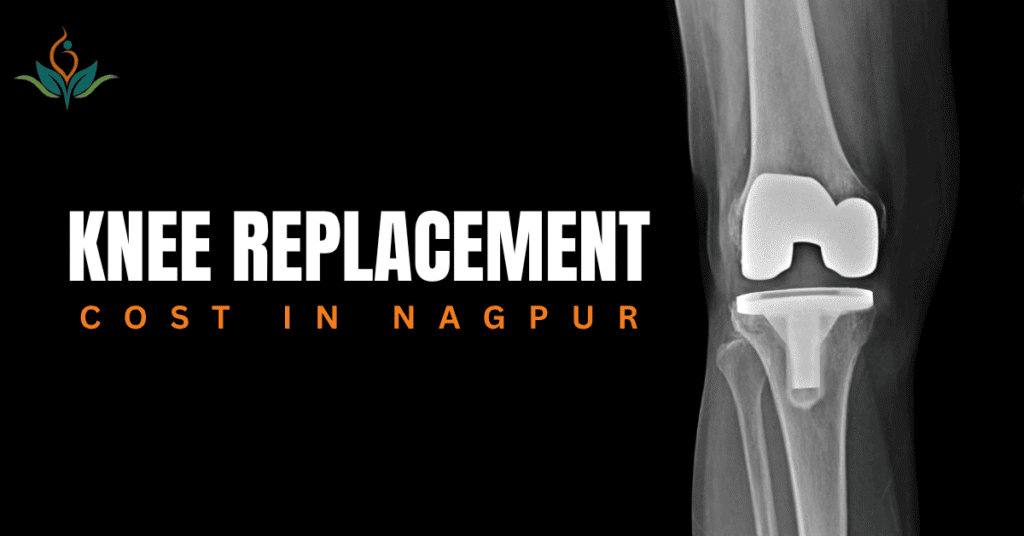 knee replacement cost in Nagpur